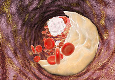 血管垃圾不及時清理會成為心腦血管疾病誘因，一招管用