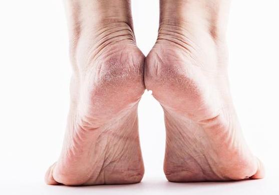 腳后跟經(jīng)常起皮開裂，是缺乏維生素嗎